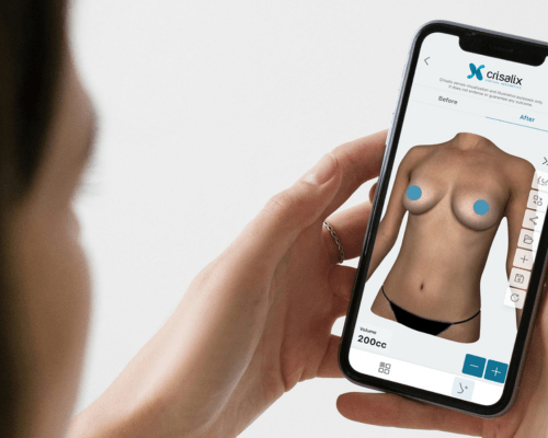 crisalix 3d imaging on iphone for breast reduction surgery